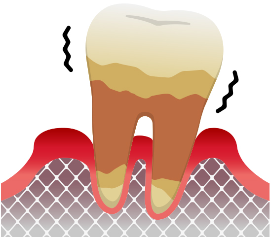 歯周炎（重度）