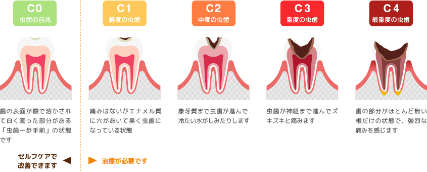 虫歯の進行具合