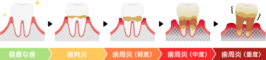 歯周病の進行度